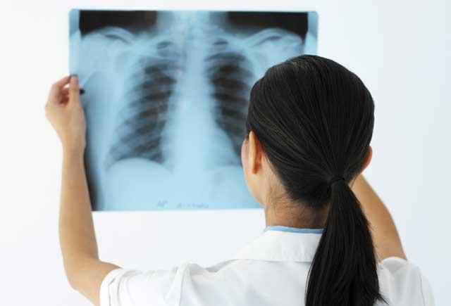 cancerul pulmonar special arad