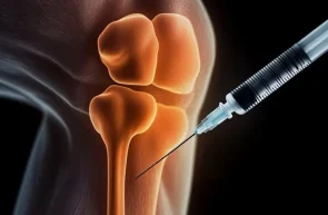 Progres în tratarea osteoporozei - un nou hidrogel crește de până la cinci ori densitatea osoasă